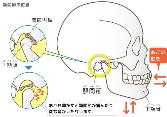 顎関節症