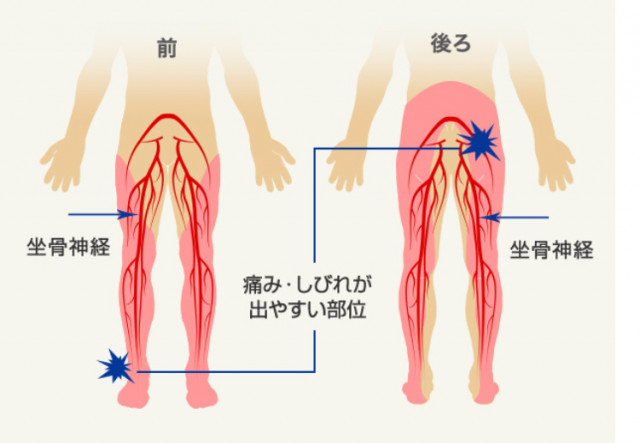 と 坐骨 は 神経痛